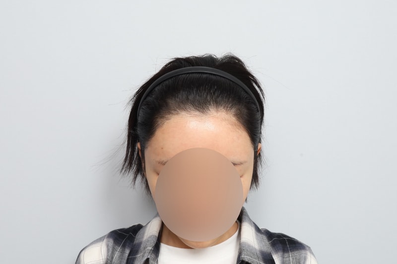 여자헤어라인 모발이식 재수술 12개월째 모원성형외과