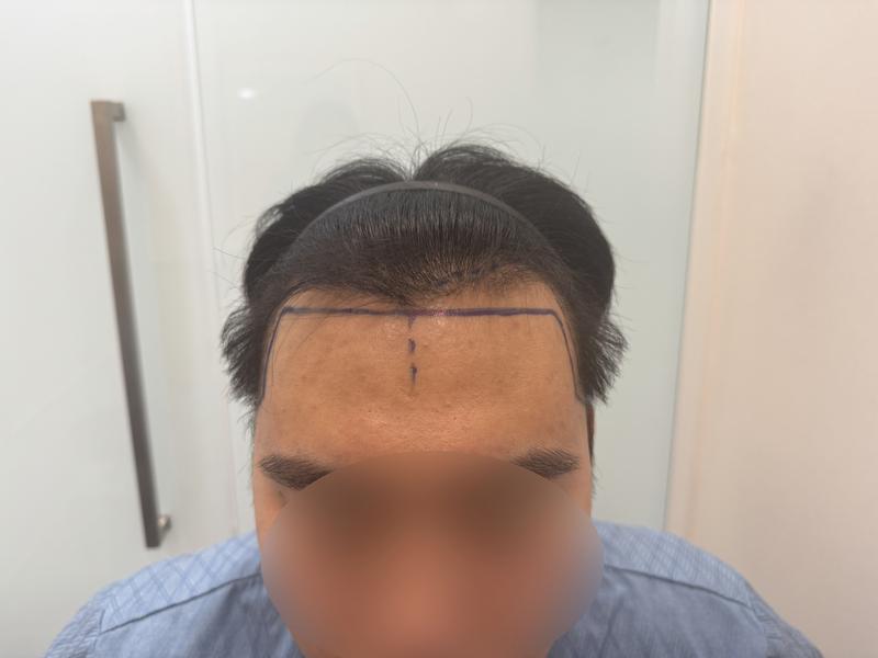 发际线无削发非切开毛发移植 1400 毛囊 第2周毛原整形外科