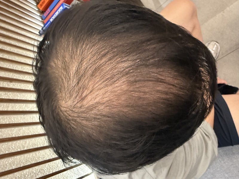 정수리 무삭발 비절개 모발이식 1500모낭 +두피문신 10일차 모원성형외과