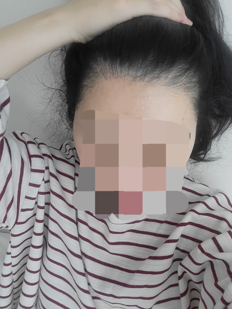 Hairline Hair Transplantation Reoperation at Mowon Plastic Surgery Clinic 12 months later (Director Park Jong-ok)
