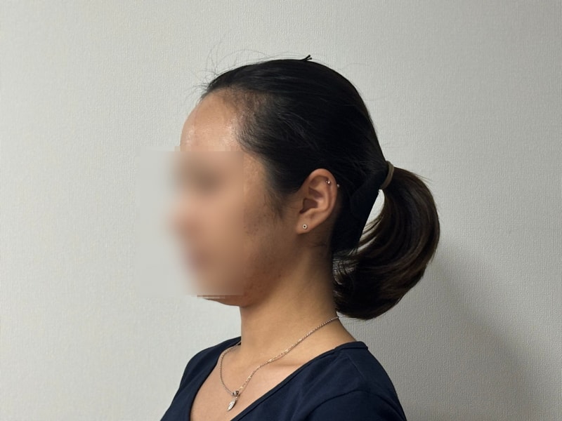 Park Jong-ok, Director of Mowon Plastic Surgery on the 10th day of non-cut hair transplantation