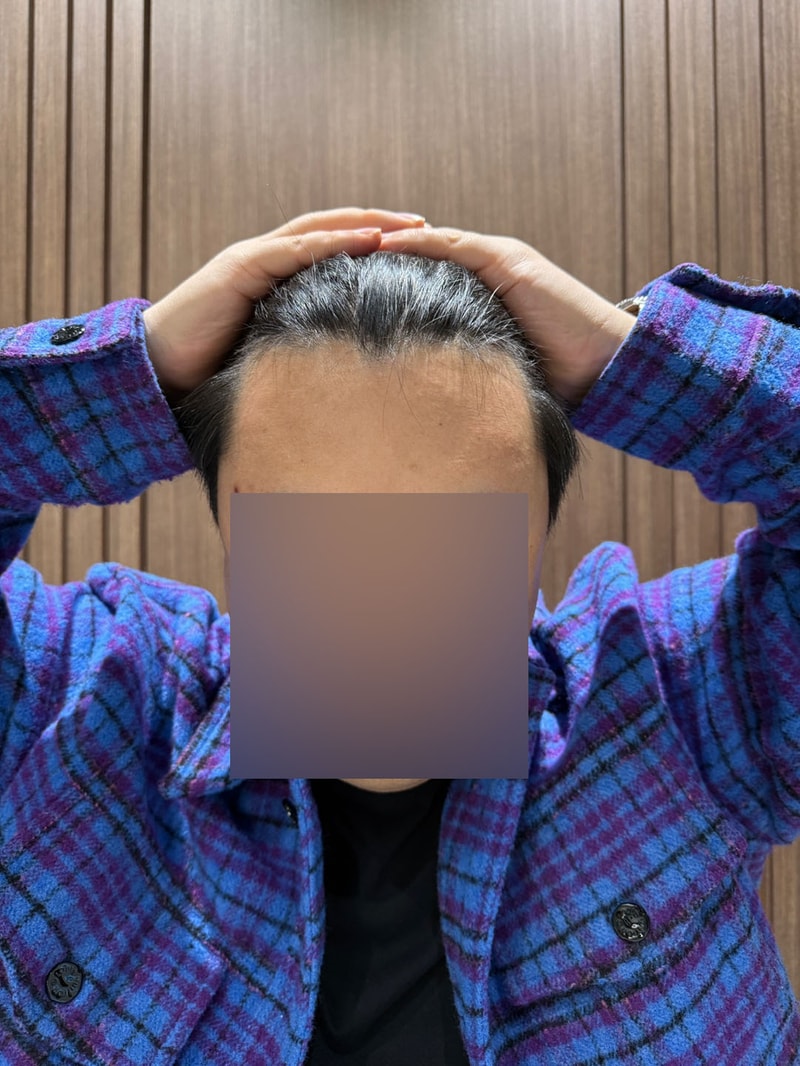 モウォン整形外科 Mザイマ 無削髪 非切開 毛髪移植3ヵ月目 チョン·ジェホン院長