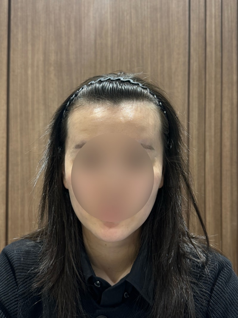 헤어라인 모발이식(비절개) 3달차 모원성형외과 박종옥원장님