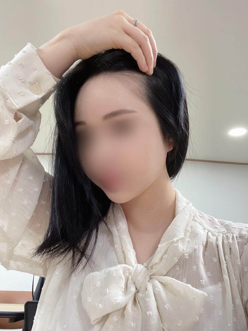 MOWON整形外科 女性发际线非切开毛发移植 7 个月