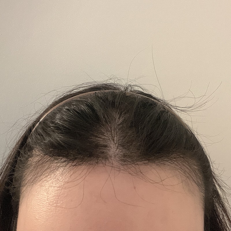 모원성형외과 여자헤어라인 무삭발 비절개 1200모낭 모발이식 7개월 차