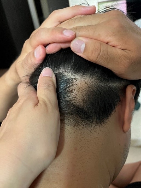 Post-stage of the 5th day of Mowon plastic surgery scar hair transplantation (Director Jeong Jae-hong)