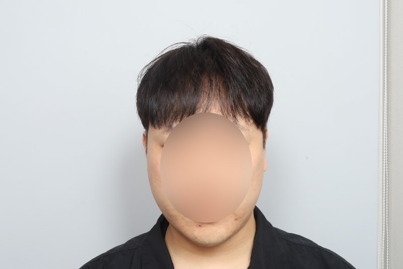 无剃头非切开毛发移植 7个月 某院整形外科郑在洪院长