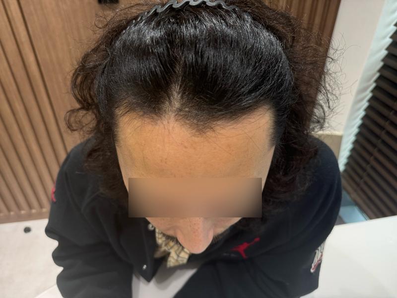 無削髪 非切開 毛髪移植 1日目 モウォン整形外科