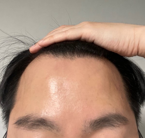 The 10th day of M-shaped incision in M-shaped plastic surgery surgery