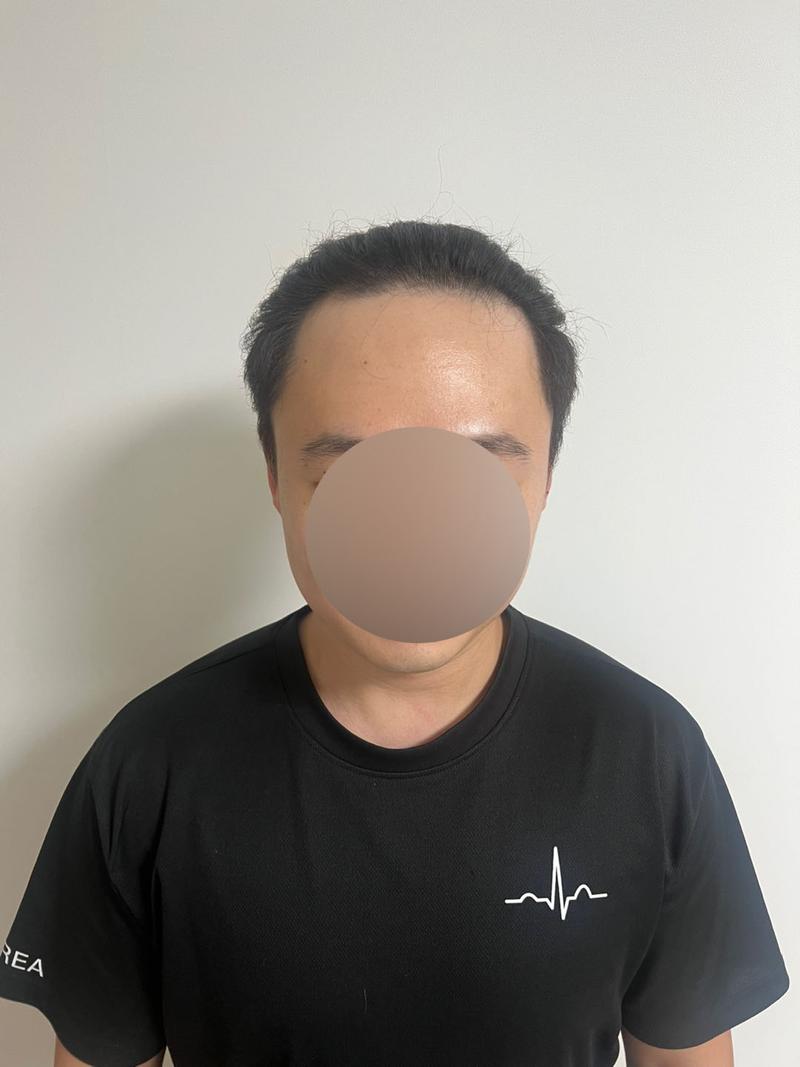 Hair transplant without cutting non-cut hairline hair transplant 2300 hair follicles 10th day hair plastic surgery