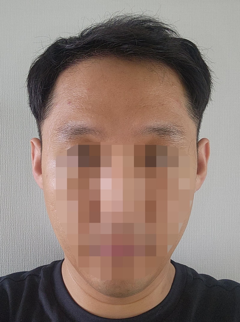 非切開毛髪移植10日目.. 男はやっぱり頭がいいみたいです