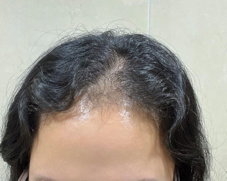 モウォン整形外科（パク·ジョンオク院長） 非切開-部分剃髪 ヘアライン矯正 7ヵ月