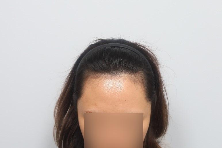 Women's Hairline Partial Cut Non-Sectional Hair Transplantation 3 Months Modular Plastic Surgery