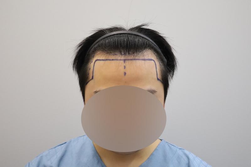 헤어라인 비절개모발이식 1일차 모원성형외과