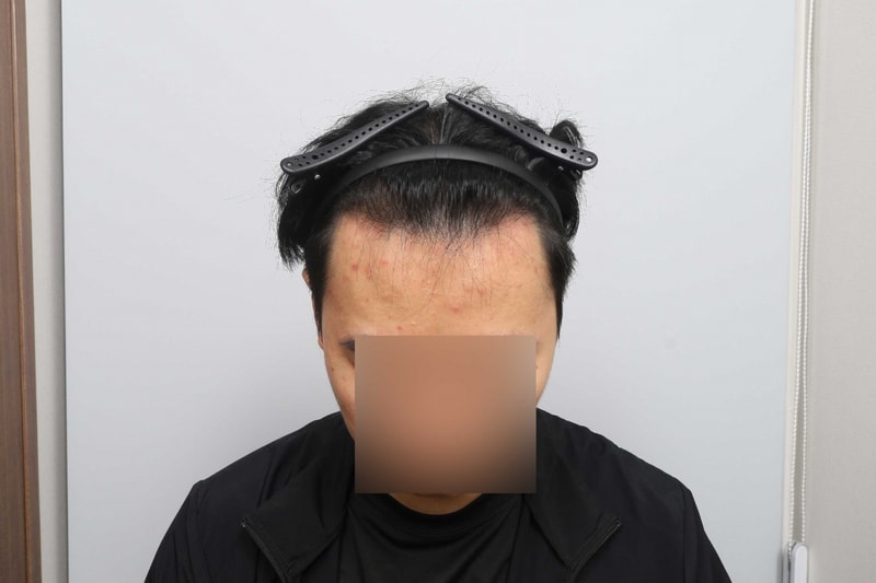 신사 모원성형외과 헤어라인 비절개모발이식 수술당일 후기