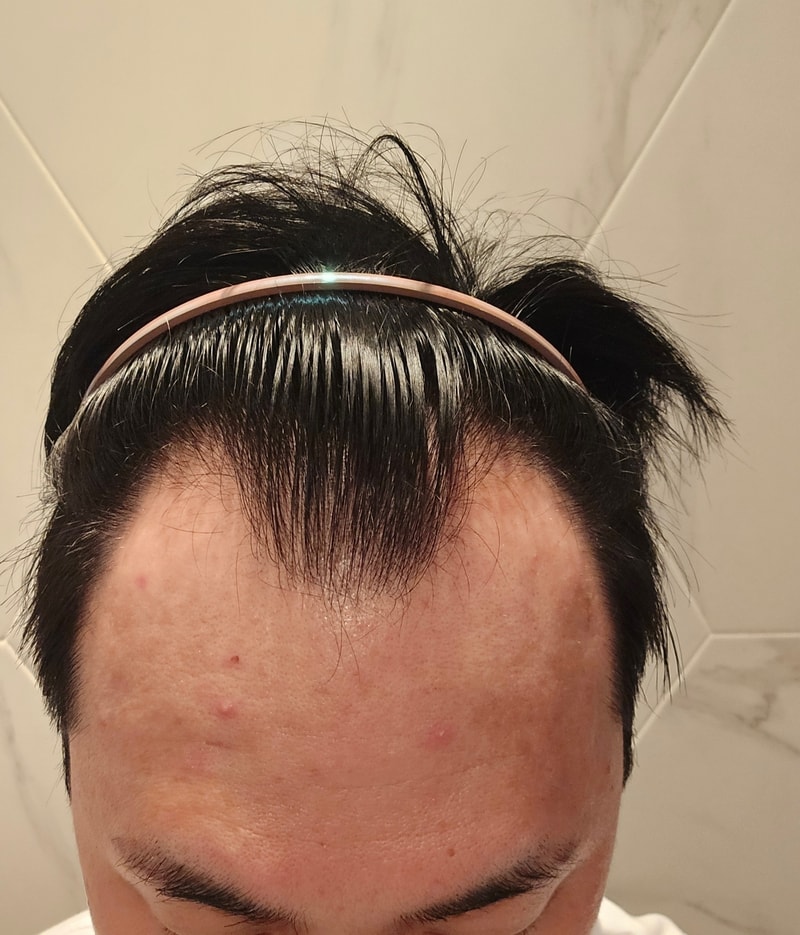 The 10th day review of hair transplantation in Mawon plastic surgery!!