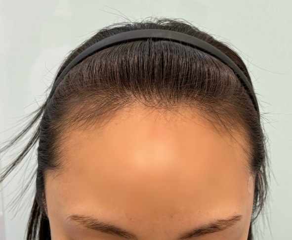 Leave a review on the 12th day after getting a hair transplant at the Mawon plastic surgery clinic
