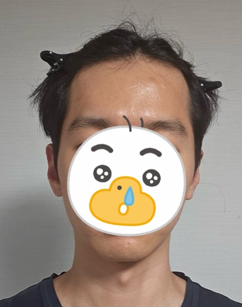 モウォン整形外科の非切開部分の剃髪を受けてから2日ですが、一度確認してください！