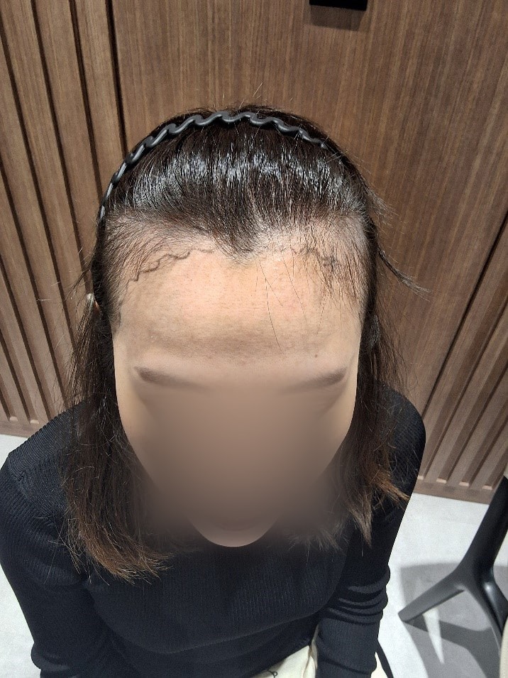 모원성형외과 헤어라인 4개월차 후기 작성해봐요