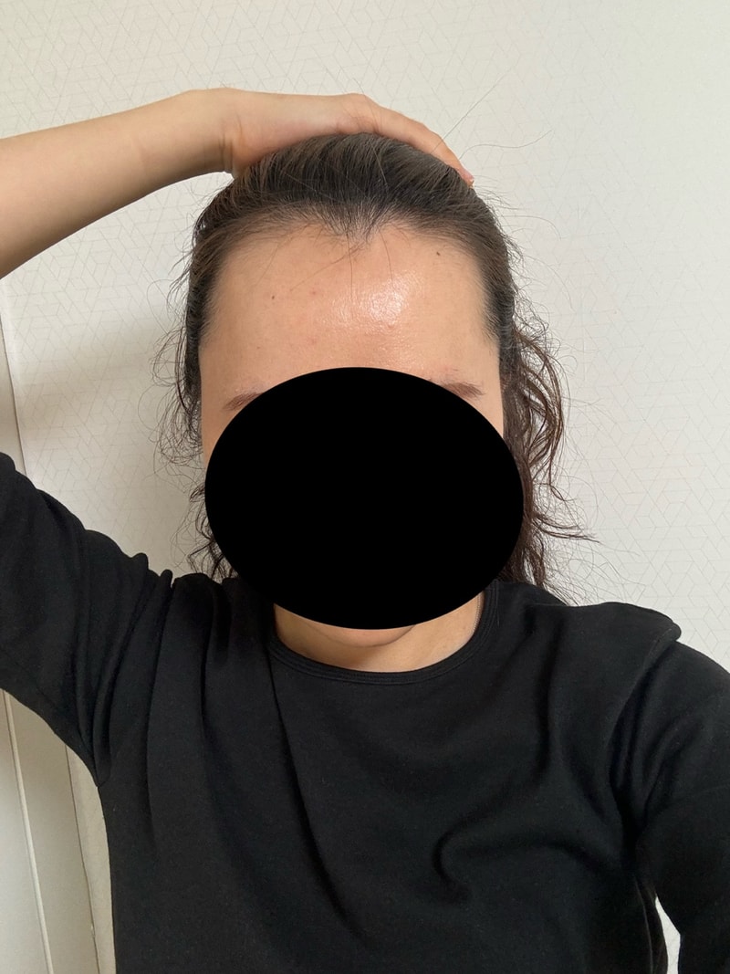 모원성형외과에서 헤어라인 무삭발 비절개모발이식 받은지 4개월차예요!
