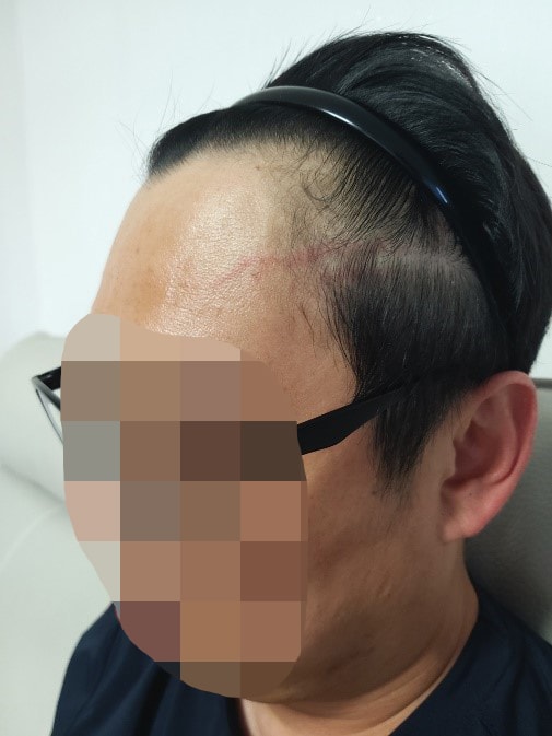 모원성형외과 비대칭 M자이마 비절개 모발이식 12개월
