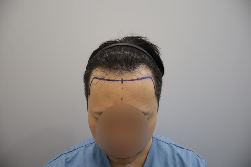 무삭발 비절개모발이식 12개월 모원성형외과 정재홍원장님