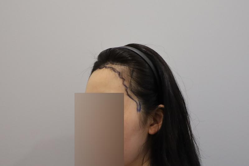 毛圆整形外科女士发际线1100毛囊第5天后记！