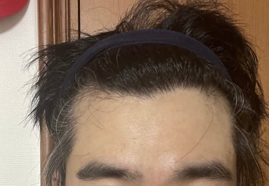 モウォン整形外科の頭頂部+M字ヘアライン<非切開ツーブロック>5日目を共有します