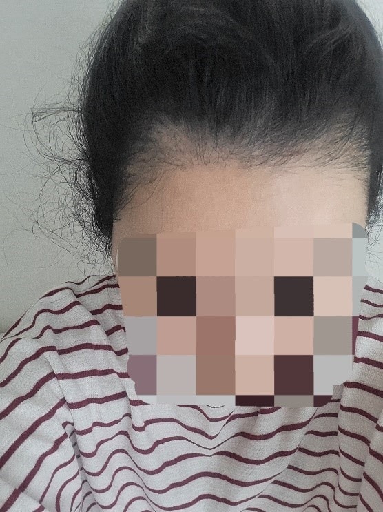 ★Mowon Plastic Surgery ★ Hairline (re-surgery) Day 10 Review~ (Director Park Jong-ok)