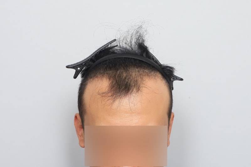 m자탈모 비절개 모발이식 2주차 모원성형외과 박종옥원장님