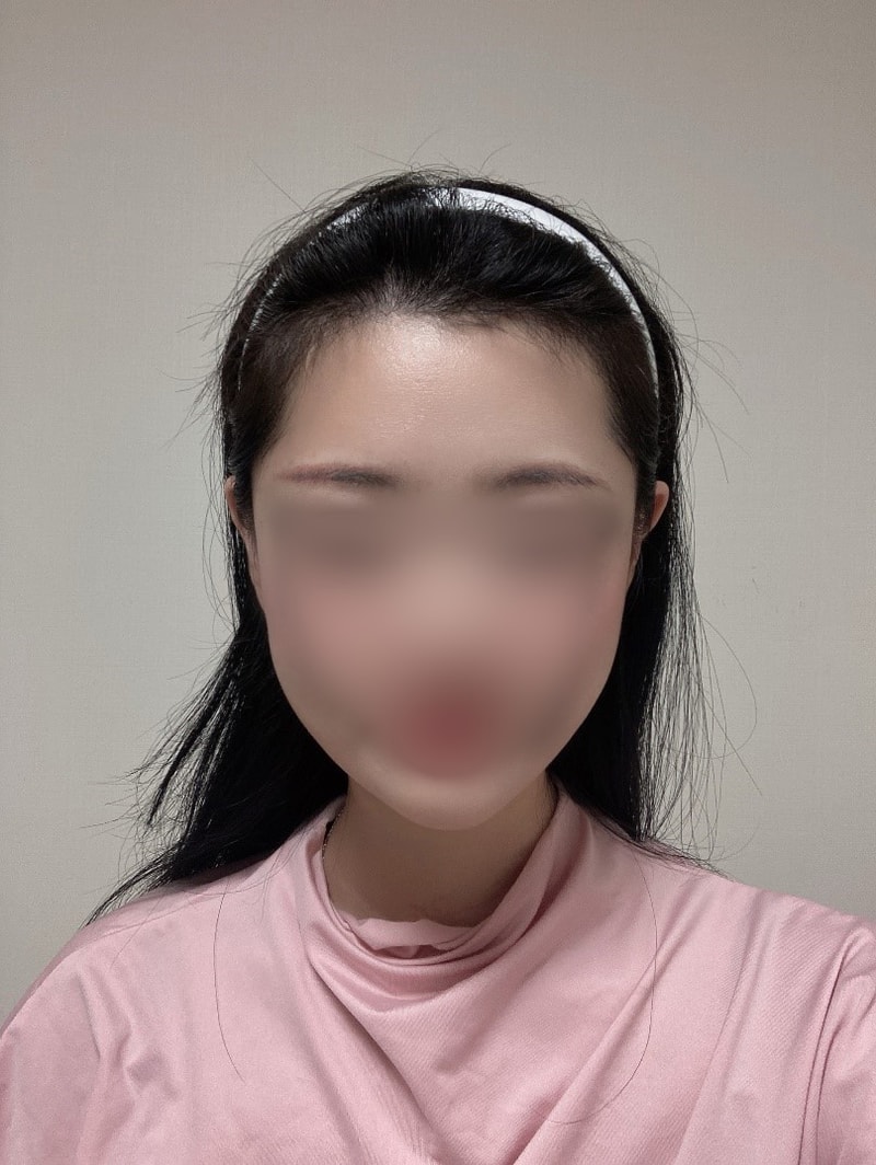 Mo Won Plastic Surgery Hair Transplantation is already 4 months old