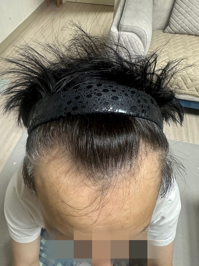 モウォン整形外科（チョン·ジェホン院長）「剃髪費切開、ヘアライン頭頂部毛髪移植」3ヵ月が経ちました