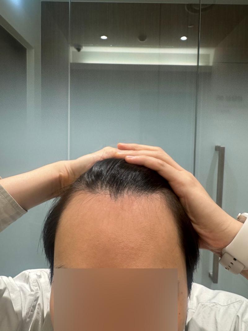 ヘアライン 非切開毛髪移植 4ヶ月 モウォン整形外科