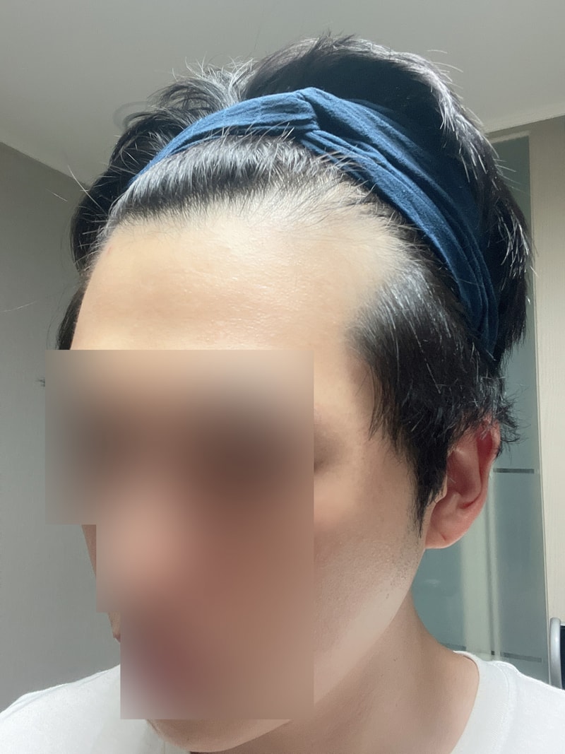 무삭발 비절개모발이식 + 두피문신 7개월 후기 모원성형외과