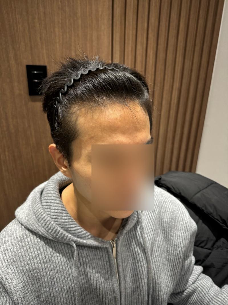 MOWON整形外科发际线非切开毛发移植第 5 天