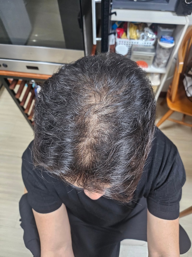 모원성형외과 부분삭발 정수리 비절개 모발이식 1년