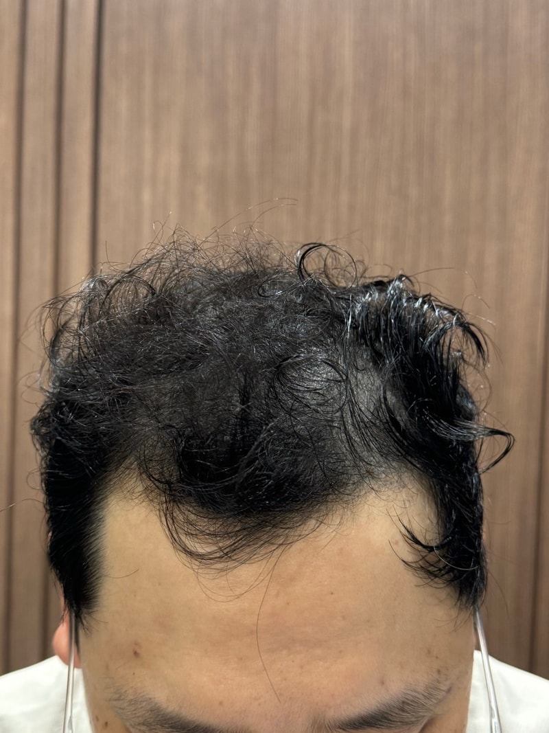 비절개모발이식 M자+정수리 모원성형외과 3개월차
