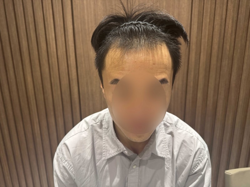 무삭발비절개 M자이마 모발이식 1800모낭 5개월차 모원성형외과 정재홍원장님