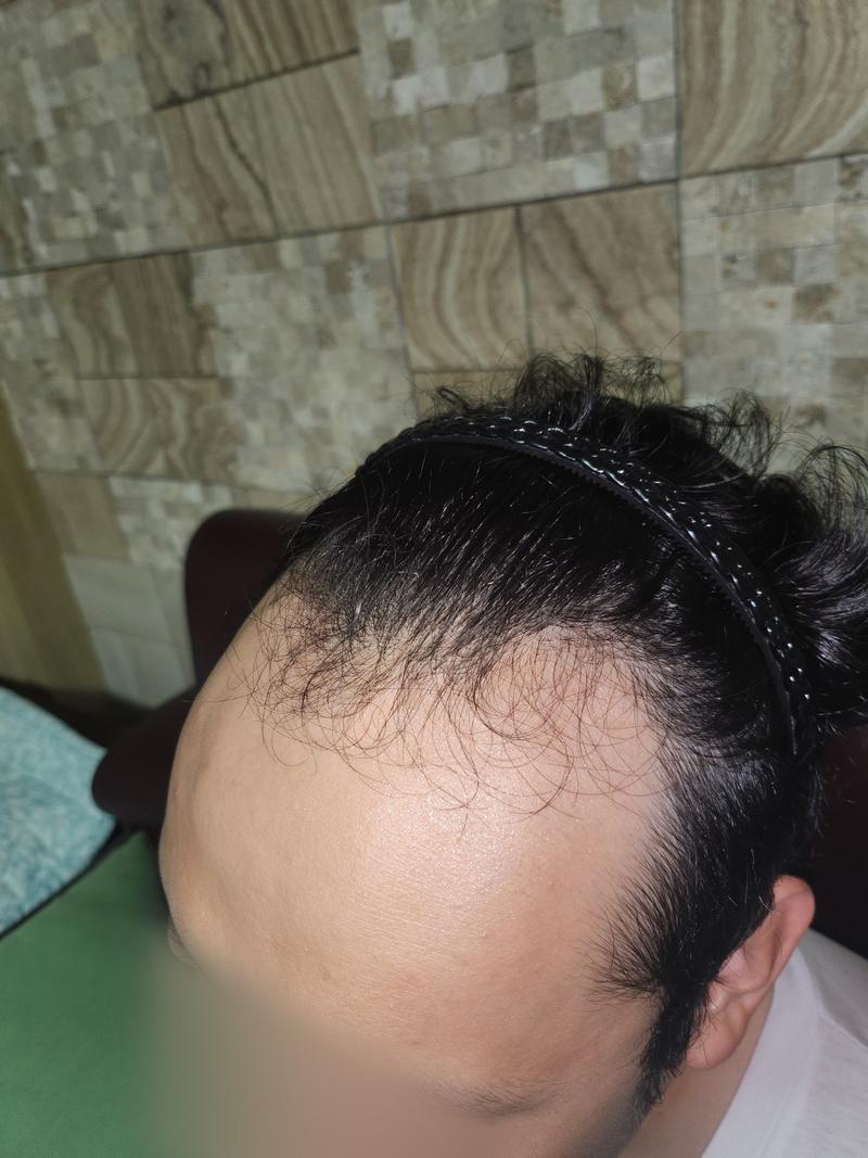 Director Jeong Jae-hong of Mowon Plastic Surgery Clinic for 3 months of non-cut hair transplantation