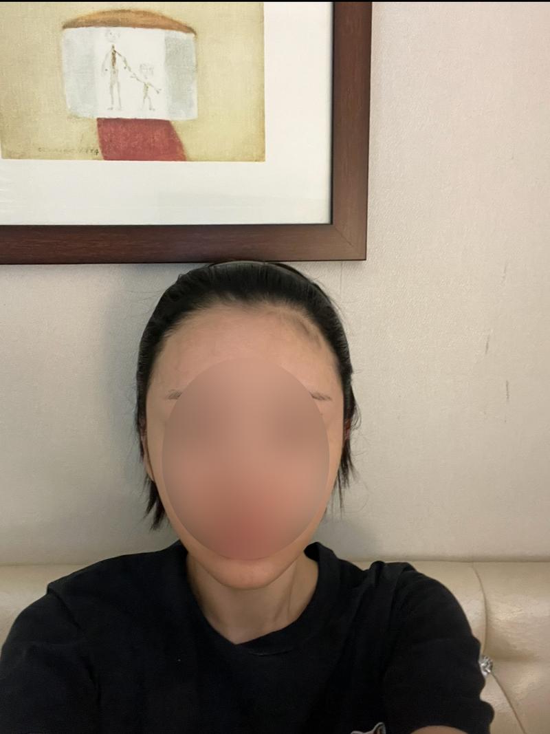 Women's Hairline Hair Transplantation Reoperation Day 10 Mawon Plastic Surgery