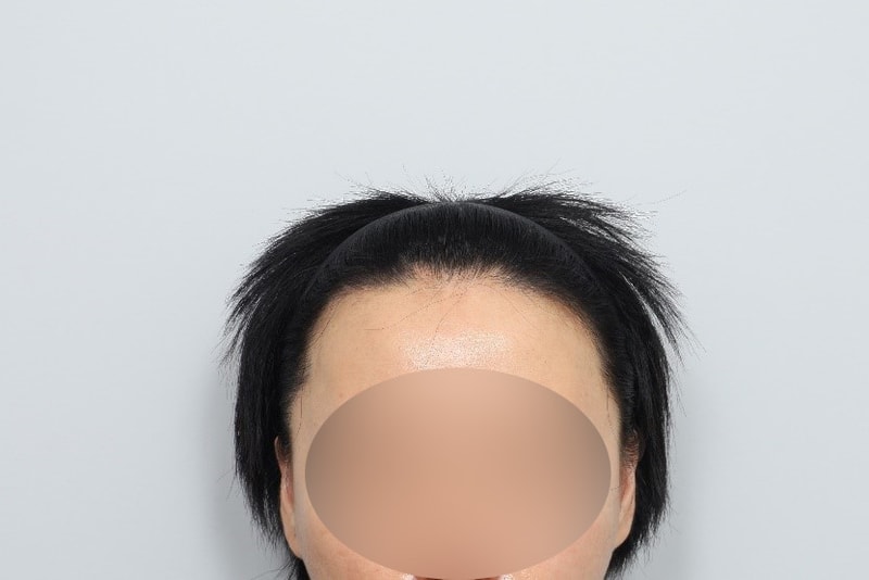 女士发际线毛发移植毛源整形外科 4 个月后期