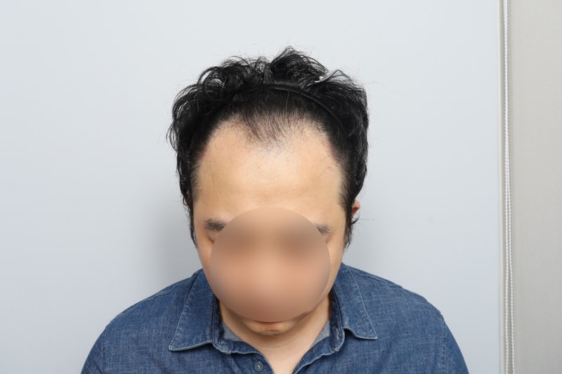 ヘアライン 大容量 毛髪移植 2105 毛包 7ヶ月 毛原整形外科
