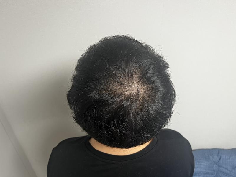 Head hair lossless cut non-cut hair transplant 2000 hair follicle hair original plastic surgery doctor Jeong Jae-hong