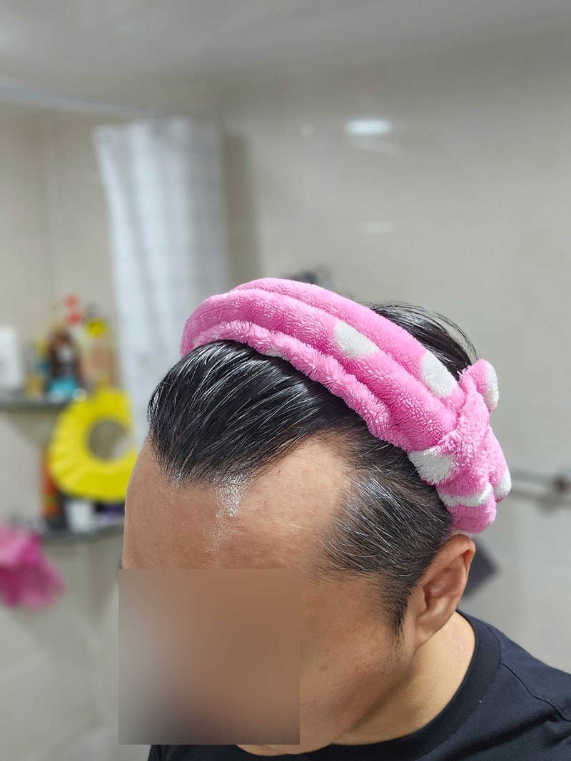 엠자이마 무삭발 비절개 모발이식 2200모낭 1일차 모원성형외과