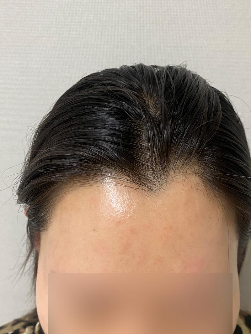 여자헤어라인 비절개모발이식 5일째 모원성형외과