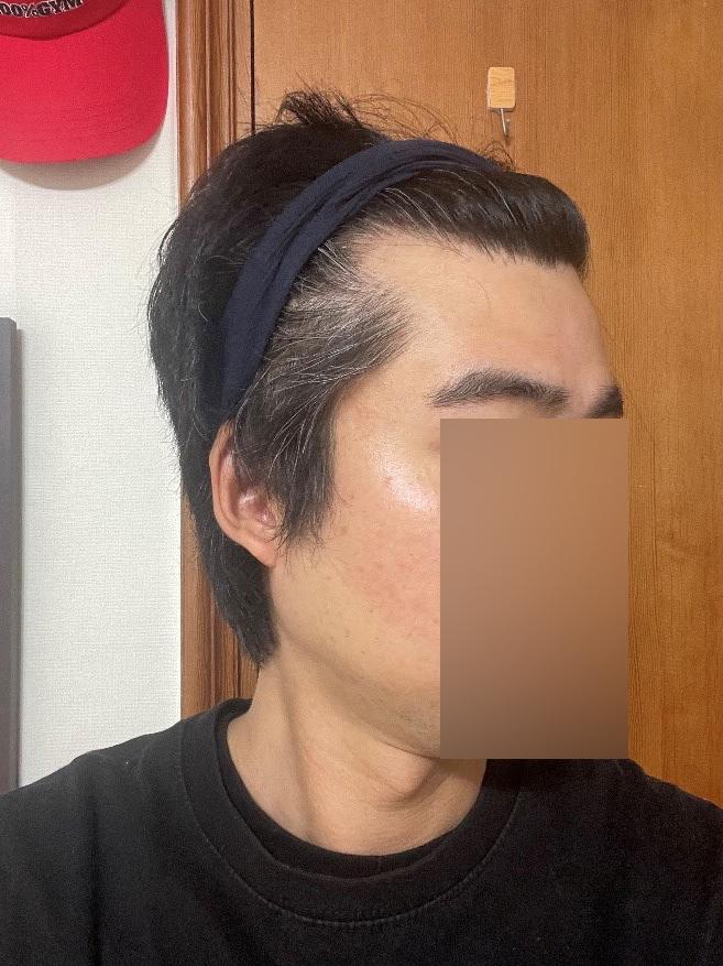 頭頂部+M字ヘアライン毛髪移植7ヶ月目のモウォン整形外科のチョン·ジェホン院長