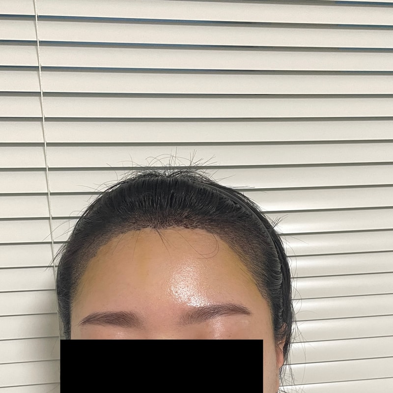 モウォン整形外科（パク·ジョンオク院長）部分剃髪費切開 1300毛包 5日になりました
