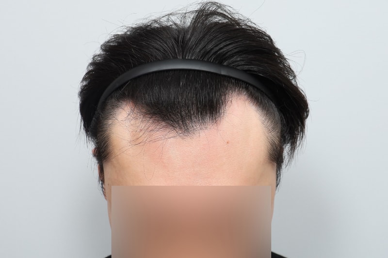 Hair Orthopedic Surgery 1900 Men's Hair Orthopedic Non-Cutting Hair Transplantation in the 2nd Week