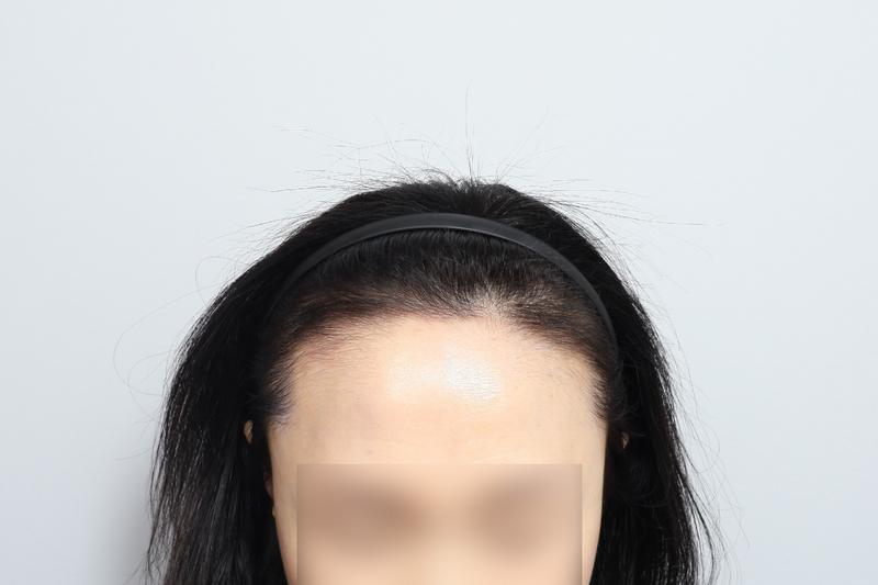 女性ヘアライン1500毛包 無削髪 非切開毛髪移植 4ヶ月 モウォン整形外科 パク·ジョンオク院長
