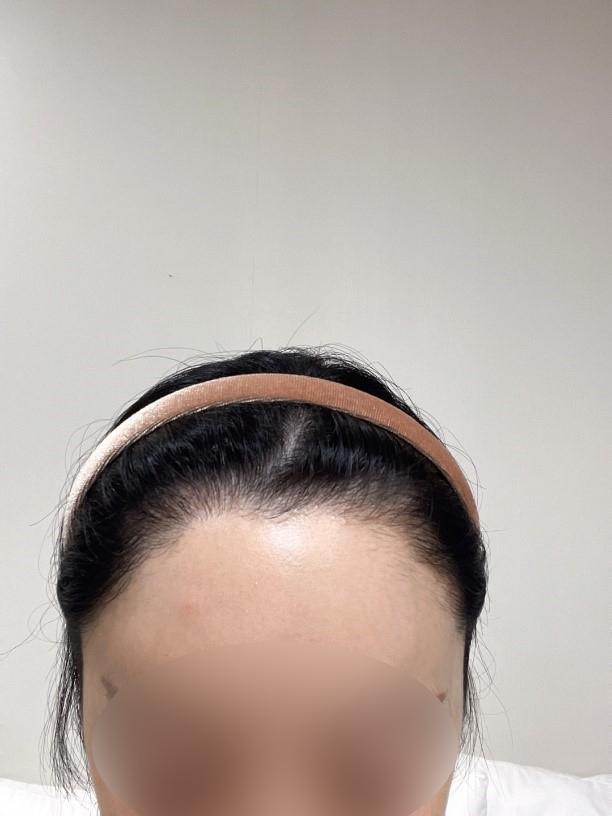 非切开毛发移植手术 3 个月 毛原整形外科